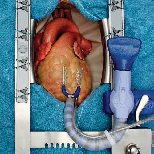 Off-pump (beating-heart) Bypass
                                    Surgery