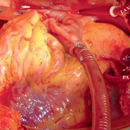 Pulmonary Endarterectomy