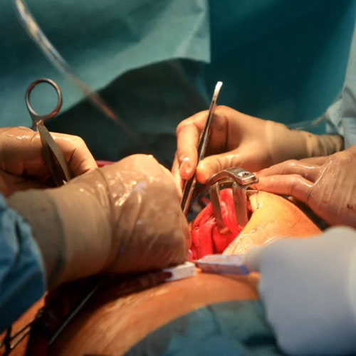 Redo and Complex Cardiac Surgeries
