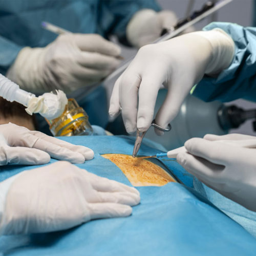 Minimally Invasive Cardiac Surgery (MICS)
